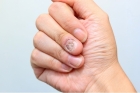 Обработка инфицированной/утолщенной ногтевой пластины (2 ногтя)