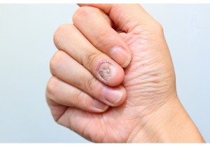 Обработка инфицированной/утолщенной ногтевой пластины (2 ногтя)